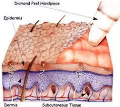 microdermabrasie1